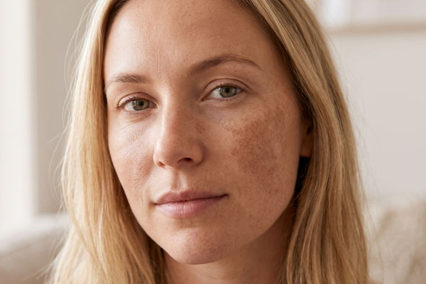 The best serum for pigmentation and dark spots during pregnancy